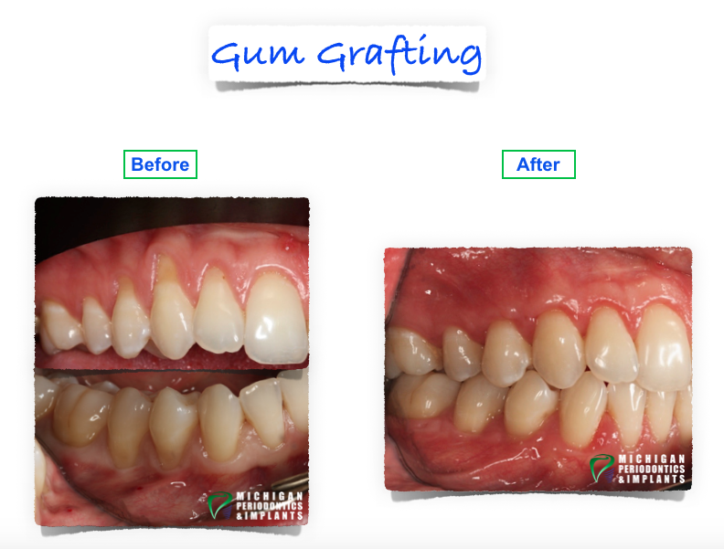 Gum Grafting