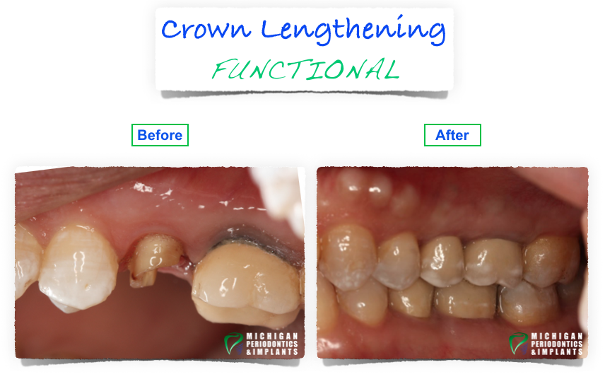 Before and After Functional Crown Lengthening