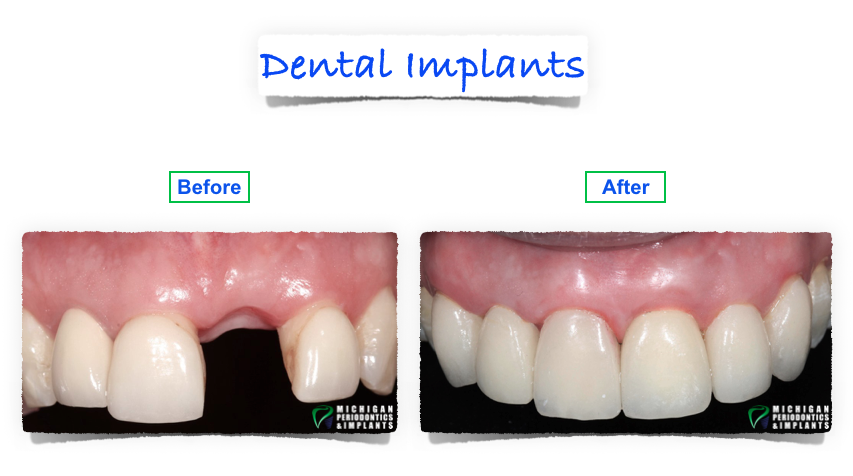 dental implants troy mi