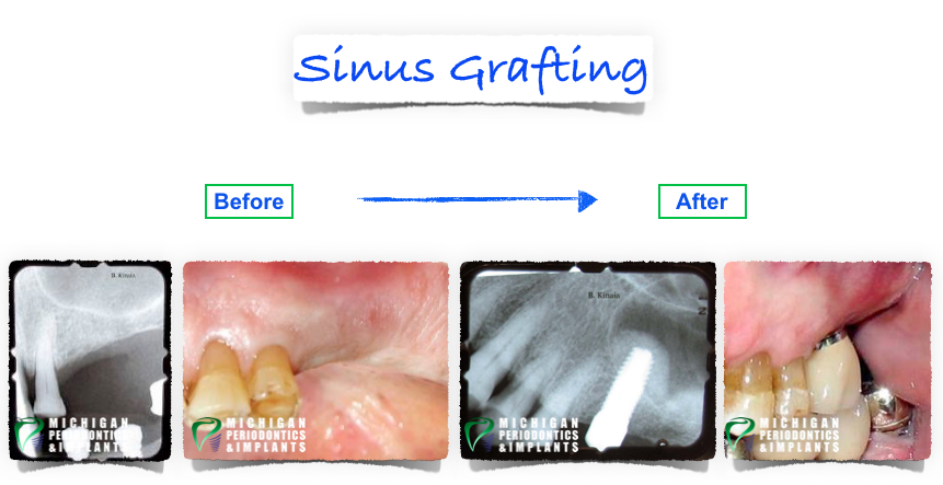 Sinus Grafting 2